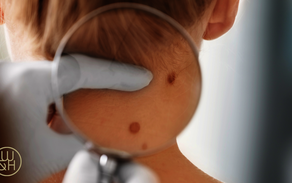 Hautkrebsvorsorge: Check das Mal!